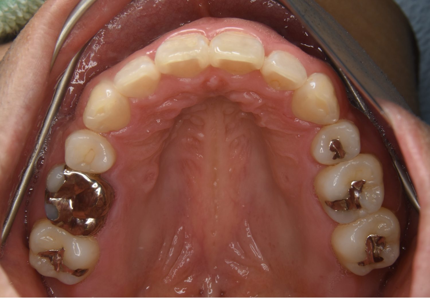 ピーススマイル矯正歯科 上下顎前突② after 上側