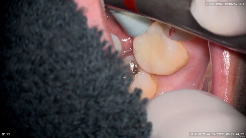 西新宿五丁目デンタルクリニック1Dayセラミックafter