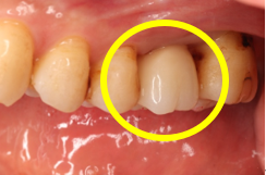 戸越なかやま歯科＋歯根破折した歯に対してRidge Preservationを行いインプラント埋入を行ったケースの症例＋補綴後の口腔写真