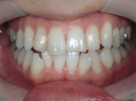 はりま歯科クリニック-ホワイトニング⑧-after-正面