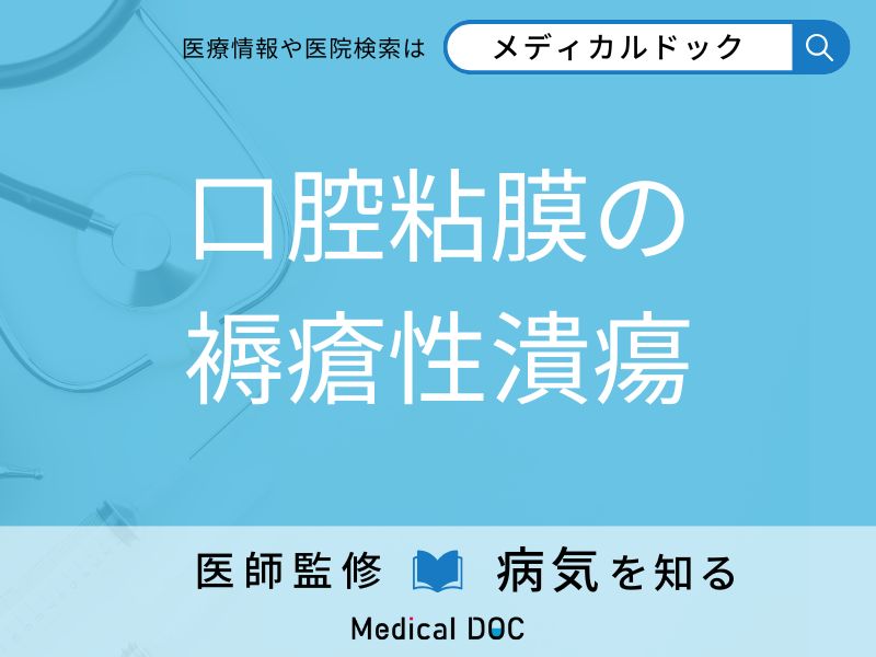 口腔粘膜の褥瘡性潰瘍