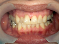 はりま歯科クリニック-ホワイトニング④-before-正面