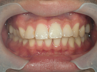 はりま歯科クリニック-ホワイトニング⑨-after-正面