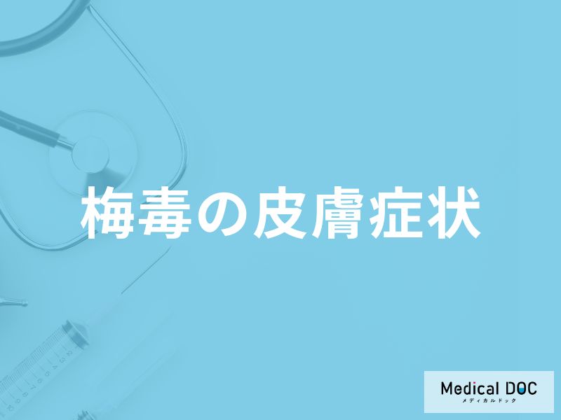 「梅毒」を発症すると「皮膚」にどんな症状が現れるかご存知ですか？【医師監修】