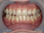 はりま歯科クリニック-ホワイトニング⑦-after-正面