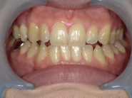 はりま歯科クリニック-ホワイトニング⑦-before-正面