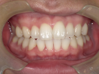 はりま歯科クリニック-ホワイトニング①-after-正面