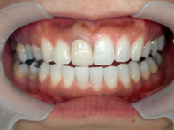 はりま歯科クリニック-ホワイトニング⑥-after-正面