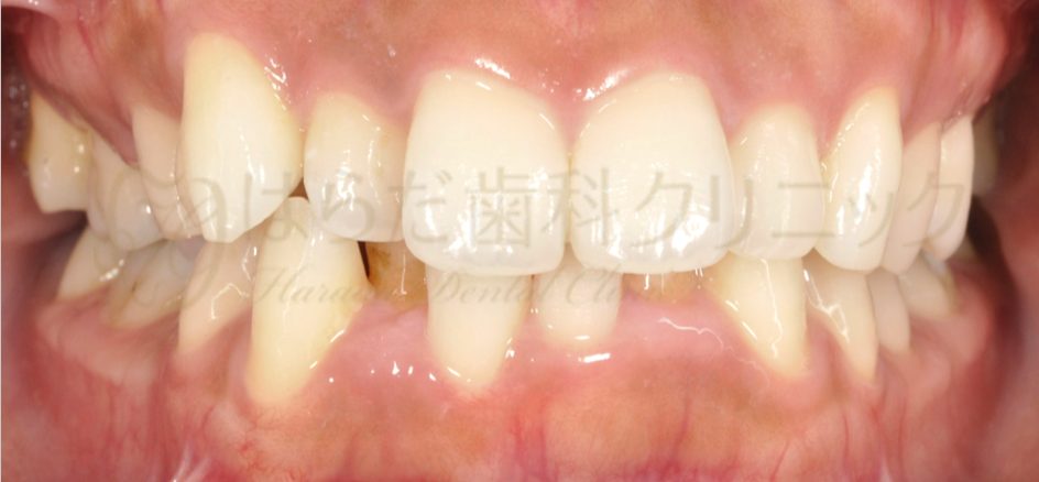 はらだ歯科クリニック 舌側矯正 before