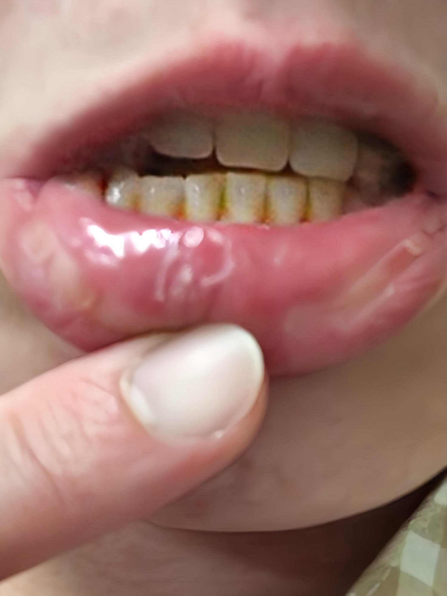 初回入院時、ステロイドの副作用で免疫力が低下し、口内にカンジダ（真菌）が生じた