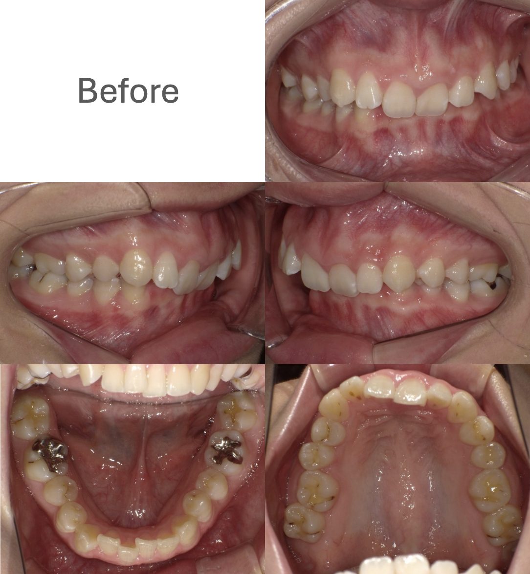 牧野歯科・矯正歯科 舌側矯正（抜歯矯正）① before