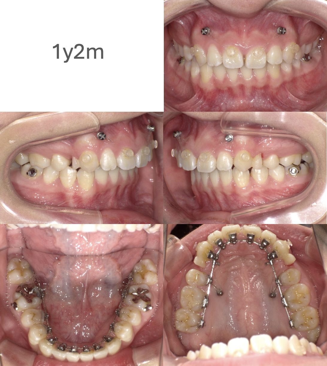 牧野歯科・矯正歯科 舌側矯正（抜歯矯正）①治療中