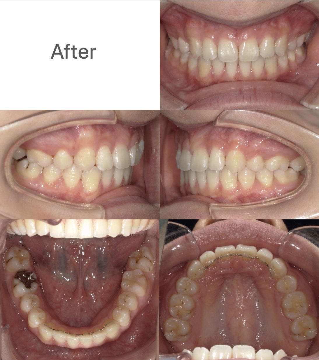 牧野歯科・矯正歯科 舌側矯正①（抜歯矯正）after