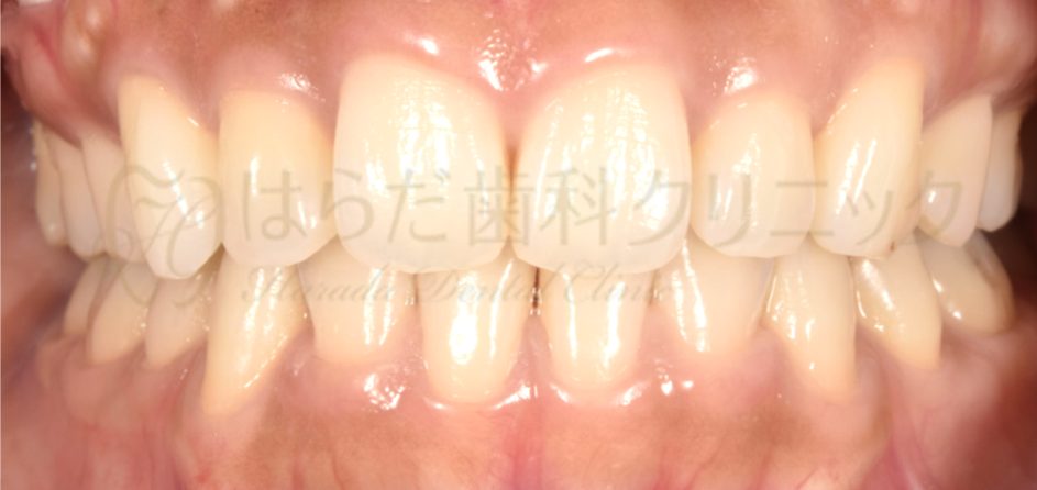 はらだ歯科クリニック 舌側矯正 after