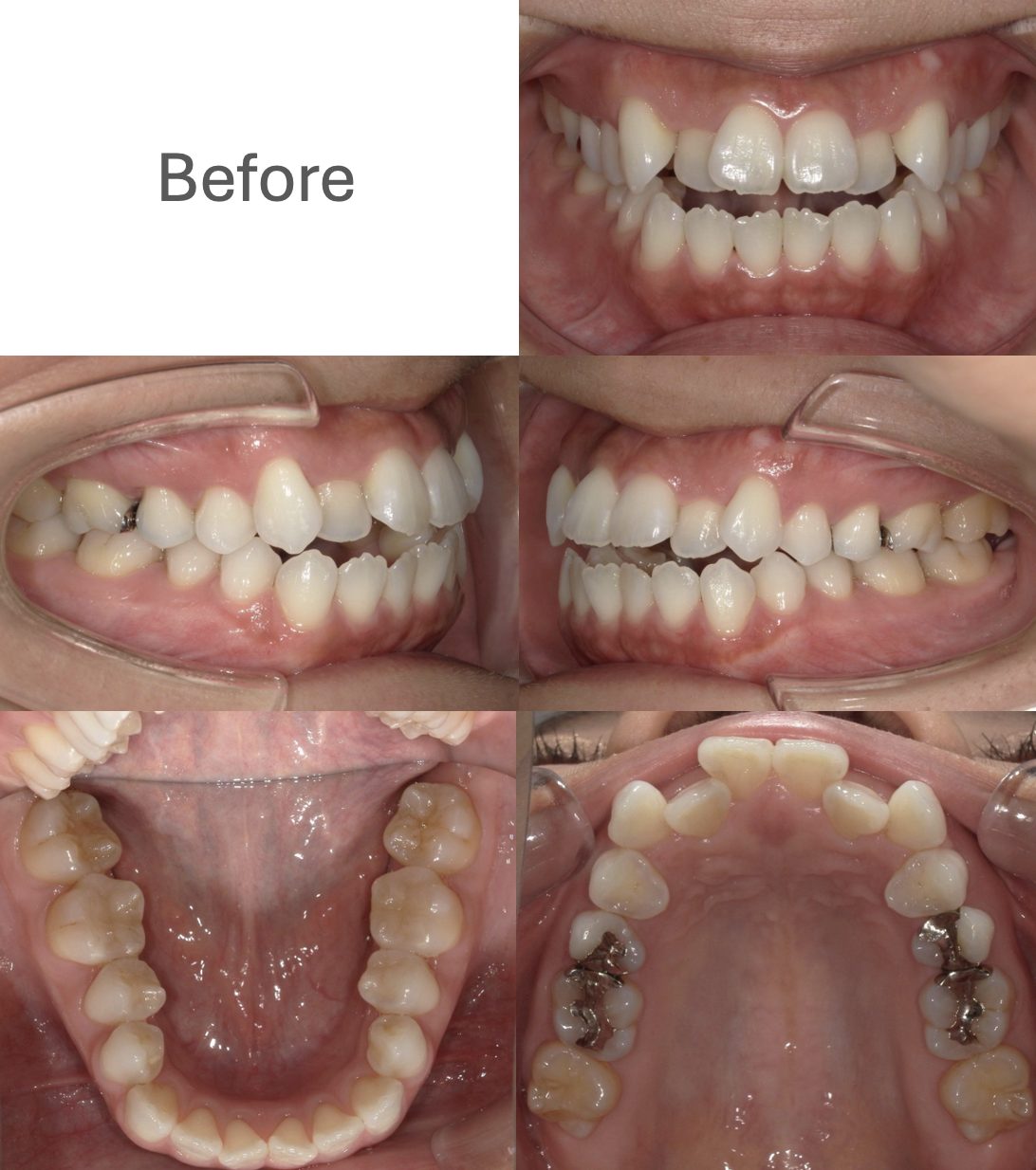 牧野歯科・矯正歯科 上下舌側矯正（非抜歯矯正） before