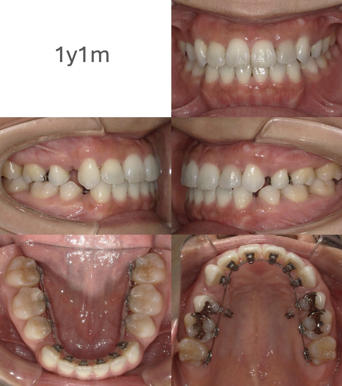 牧野歯科・矯正歯科 上下舌側矯正（非抜歯矯正）治療中