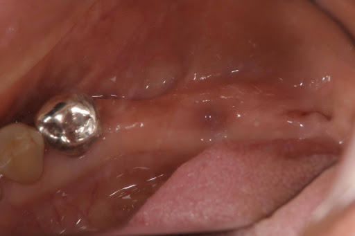 慶歯科医院 臼歯部3本欠損症例 before