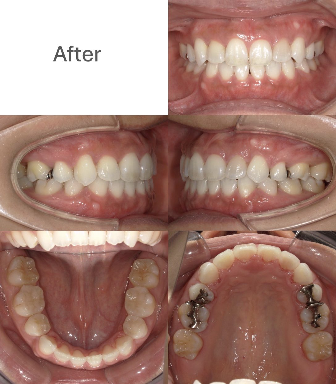 牧野歯科・矯正歯科 上下舌側矯正（非抜歯矯正）after