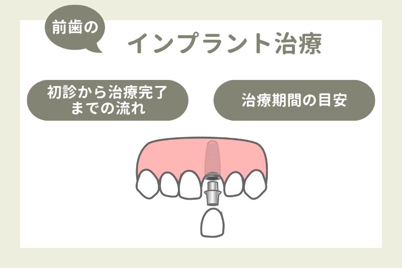 前歯のインプラントの治療の流れと治療期間