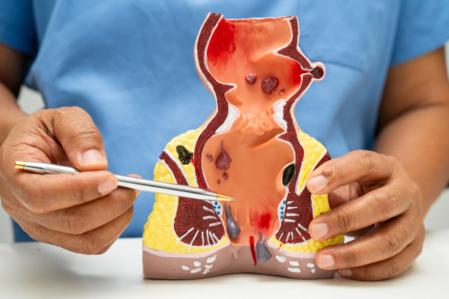 切らない痔の治療とは?