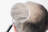 「植毛」をすればすぐに髪の毛が生えてくる？ 結果が現れるまでの期間を医師に聞く