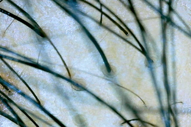 薄毛治療にはどのような方法がある?