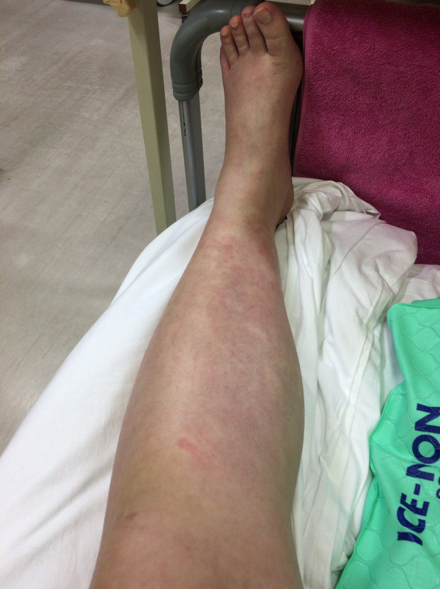 初回入院当日_皮膚筋炎の症状として下腿全体の腫れ