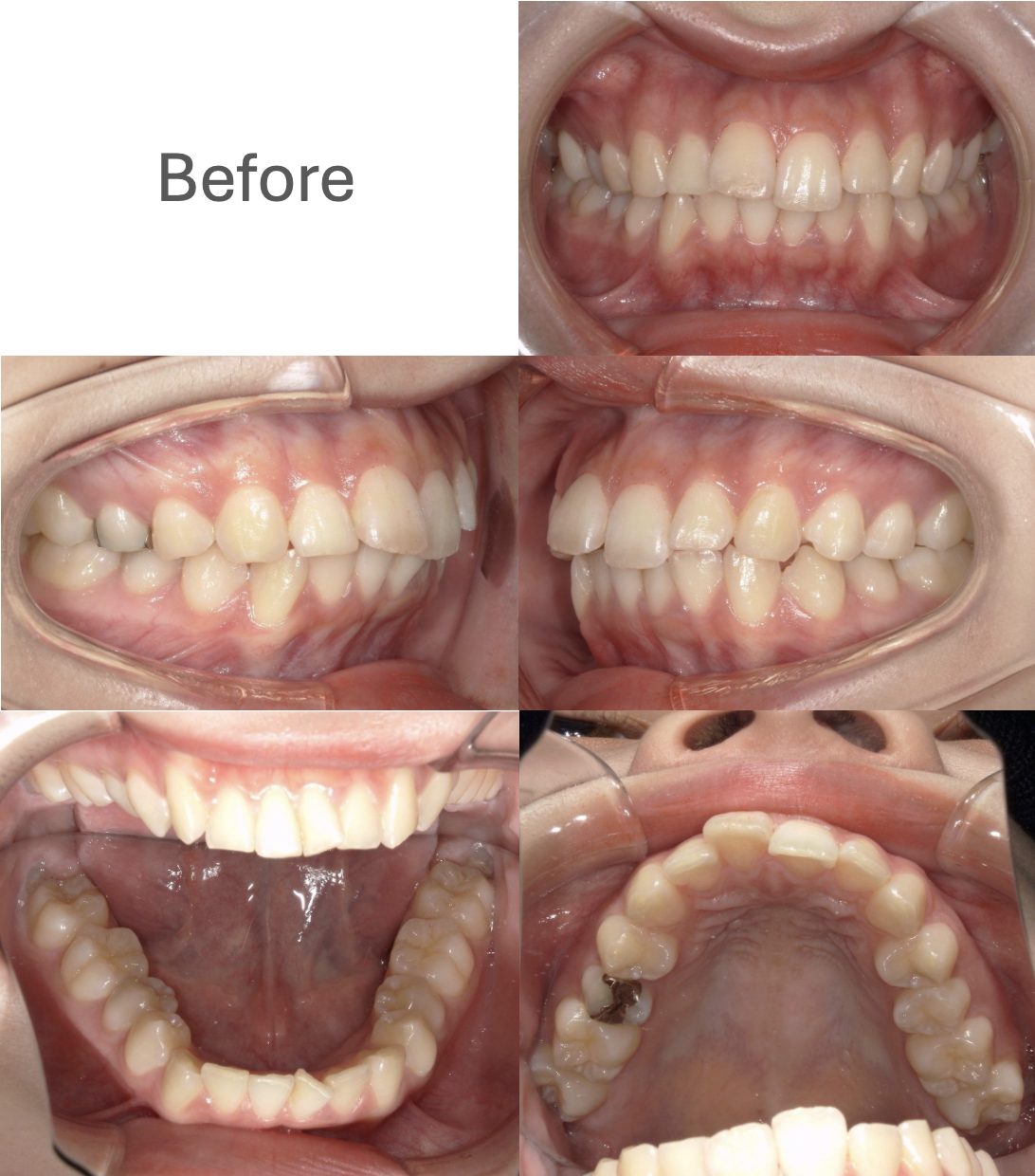 牧野歯科・矯正歯科 舌側矯正（抜歯矯正）② before