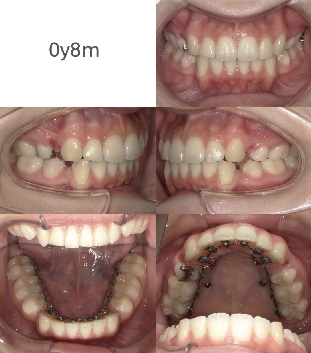 牧野歯科・矯正歯科 舌側矯正（抜歯矯正）②治療中
