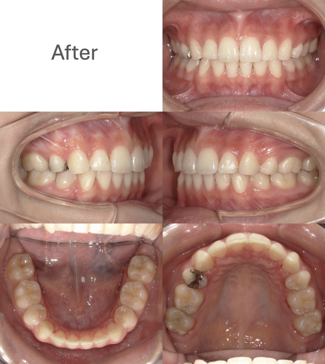 牧野歯科・矯正歯科 舌側矯正（抜歯矯正）②after