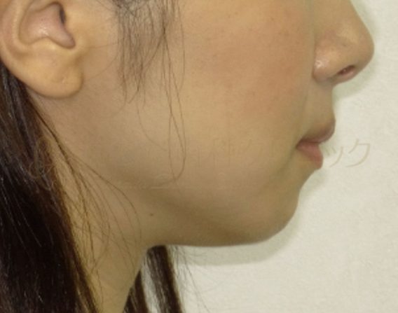 はらだ歯科クリニック 舌側矯正 after