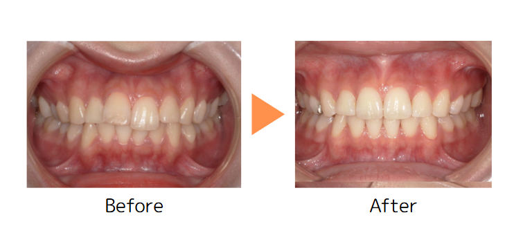 牧野歯科・矯正歯科 舌側矯正（抜歯矯正）② before after