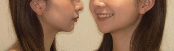 牧野歯科・矯正歯科 舌側矯正（抜歯矯正）②after 顔貌写真