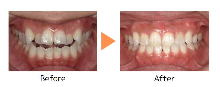 牧野歯科・矯正歯科 上下舌側矯正（非抜歯矯正） before after
