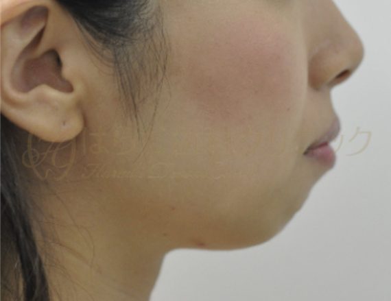 はらだ歯科クリニック 舌側矯正 before