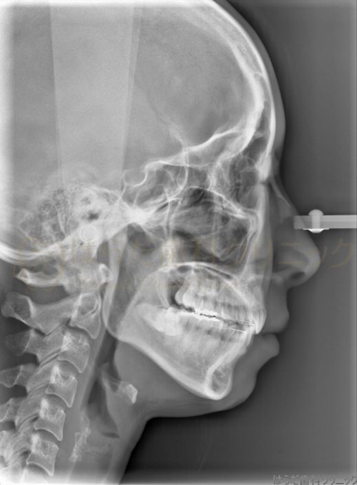 はらだ歯科クリニック 舌側矯正 after