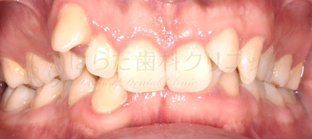 はらだ歯科クリニック ワイヤー矯正② before