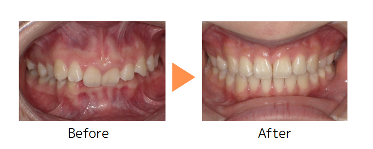 牧野歯科・矯正歯科 舌側矯正（抜歯矯正）① before after