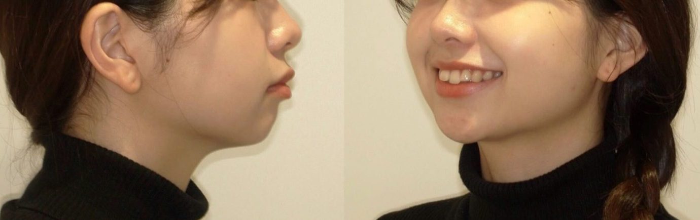 牧野歯科・矯正歯科 舌側矯正（抜歯矯正）② before 顔貌写真