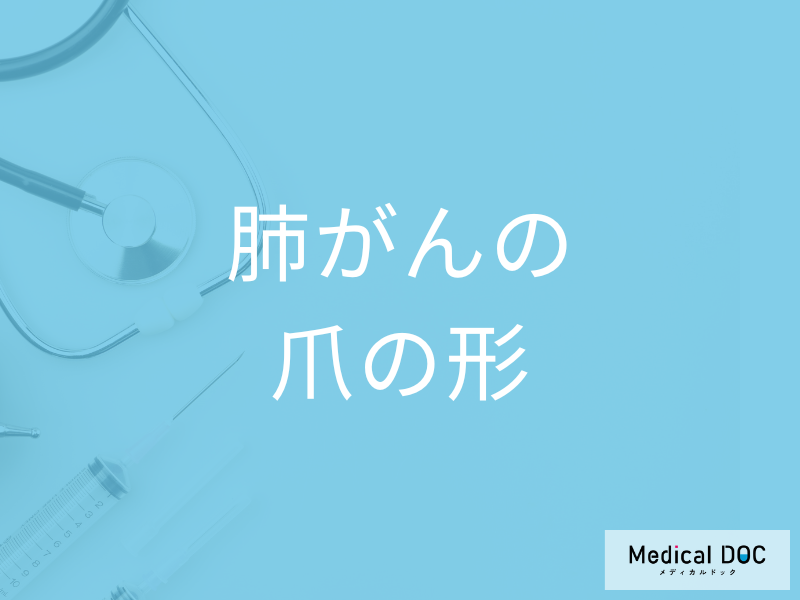 「肺がん」を発症すると「爪の形」はどのように変化する？医師が徹底解説！