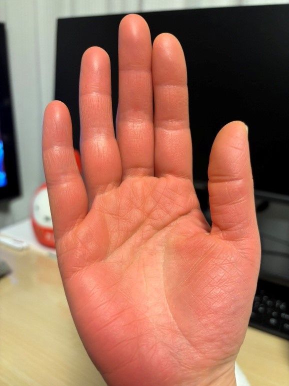 初回入院当日_皮膚筋炎の症状として表れた手の腫れ