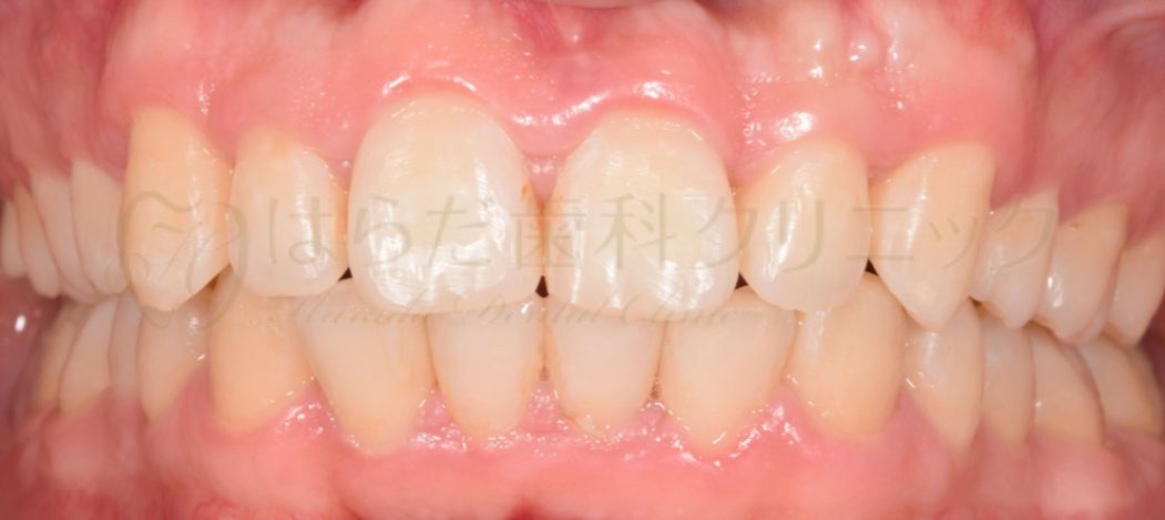 はらだ歯科クリニック ワイヤー矯正② after