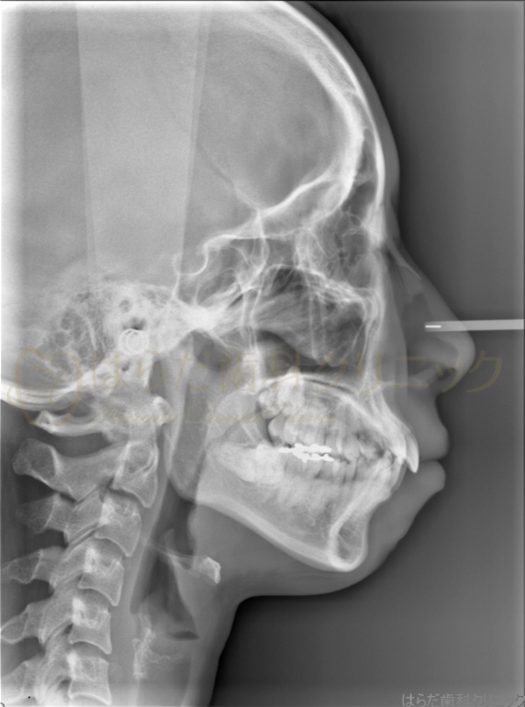 はらだ歯科クリニック 舌側矯正 before