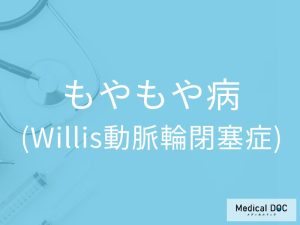 もやもや病（Willis動脈輪閉塞症）