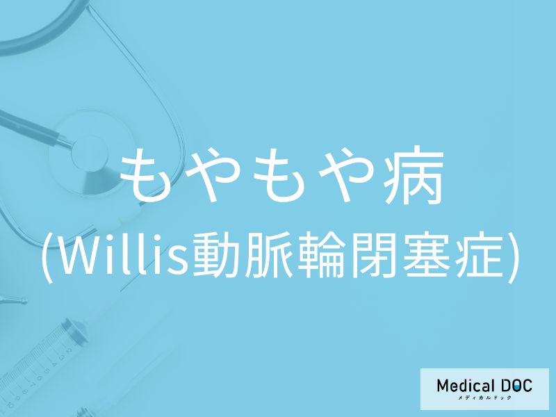 もやもや病（Willis動脈輪閉塞症）