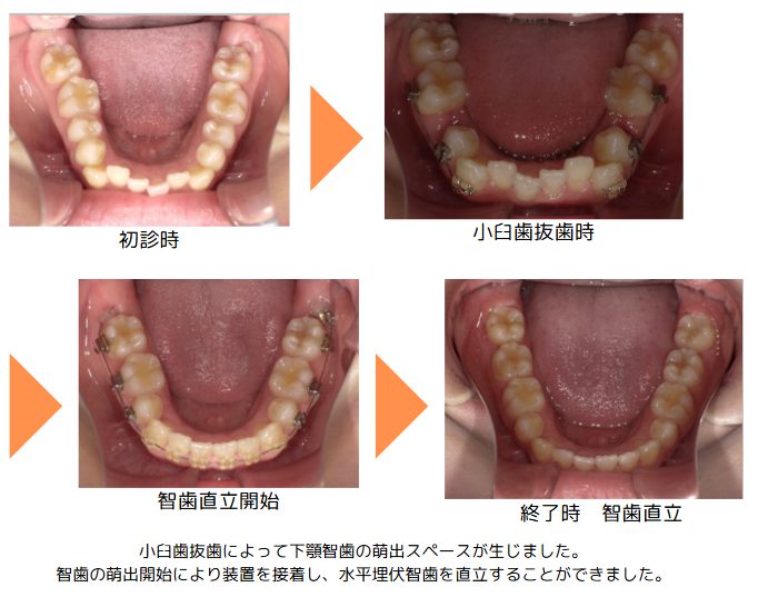 野田矯正歯科クリニック・小臼歯抜歯治療の症例紹介・Before～After・口腔内下