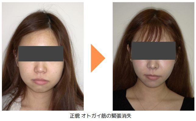 野田矯正歯科クリニック・小臼歯抜歯治療の症例紹介・Before～After・顔貌正面