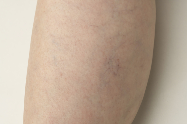 下肢静脈瘤のタイプ分け