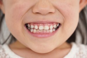 知らないと損する！痛みを抑えた小児矯正のために知っておきたいポイント