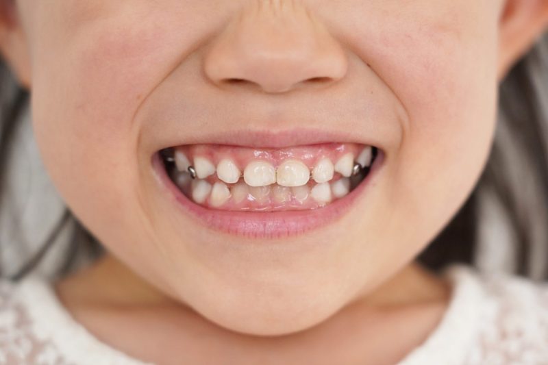 知らないと損する!痛みを抑えた小児矯正のために知っておきたいポイント